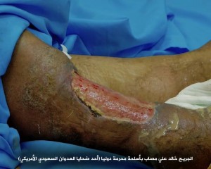 صابات بمركز الحروق بصنعاء تعرضت لقصف من أسلحة محرمة دولياً