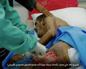 صابات بمركز الحروق بصنعاء تعرضت لقصف من أسلحة محرمة دولياً1