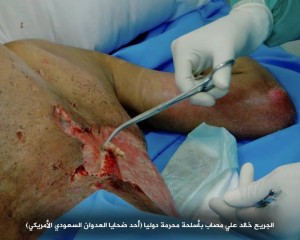 صابات بمركز الحروق بصنعاء تعرضت لقصف من أسلحة محرمة دولياً2