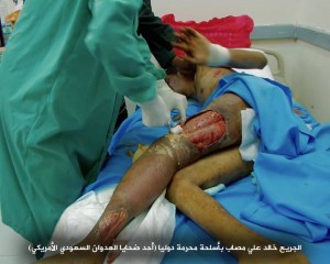 صابات بمركز الحروق بصنعاء تعرضت لقصف من أسلحة محرمة دولياً4