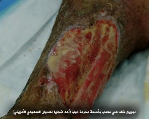 صابات بمركز الحروق بصنعاء تعرضت لقصف من أسلحة محرمة دولياً6