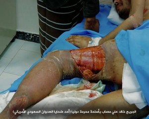 صابات بمركز الحروق بصنعاء تعرضت لقصف من أسلحة محرمة دولياً7