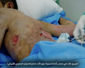 صابات بمركز الحروق بصنعاء تعرضت لقصف من أسلحة محرمة دولياً8