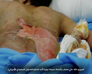 صابات بمركز الحروق بصنعاء تعرضت لقصف من أسلحة محرمة دولياً9