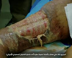 قسم الحروق بمستشفى الثورة بالحديدة يكشف عن مصابين بحروق كيميائية جراء العدوان